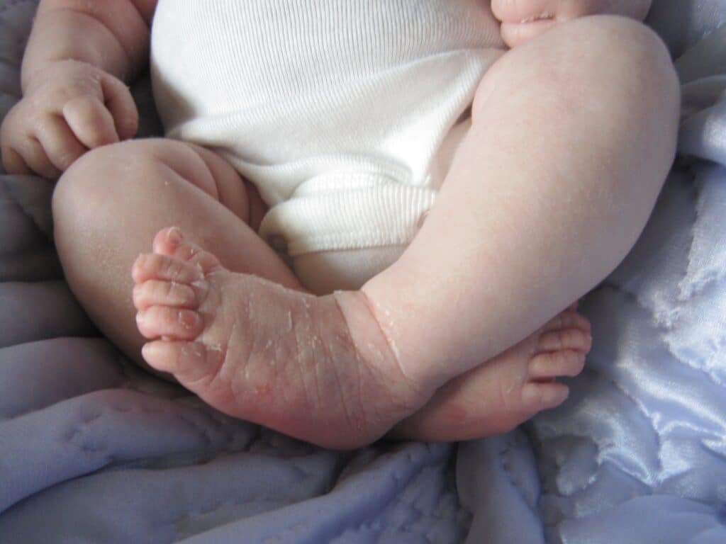 Dry, peeling newborn feet.